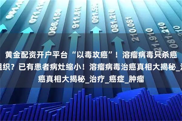 黄金配资开户平台 “以毒攻癌”！溶瘤病毒只杀癌细胞不伤正常组织？已有患者病灶缩小！溶瘤病毒治癌真相大揭秘_治疗_癌症_肿瘤
